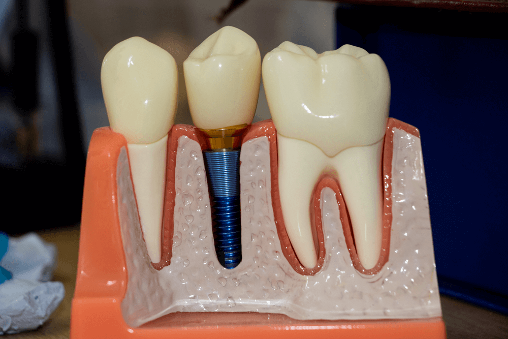 artificial teeth